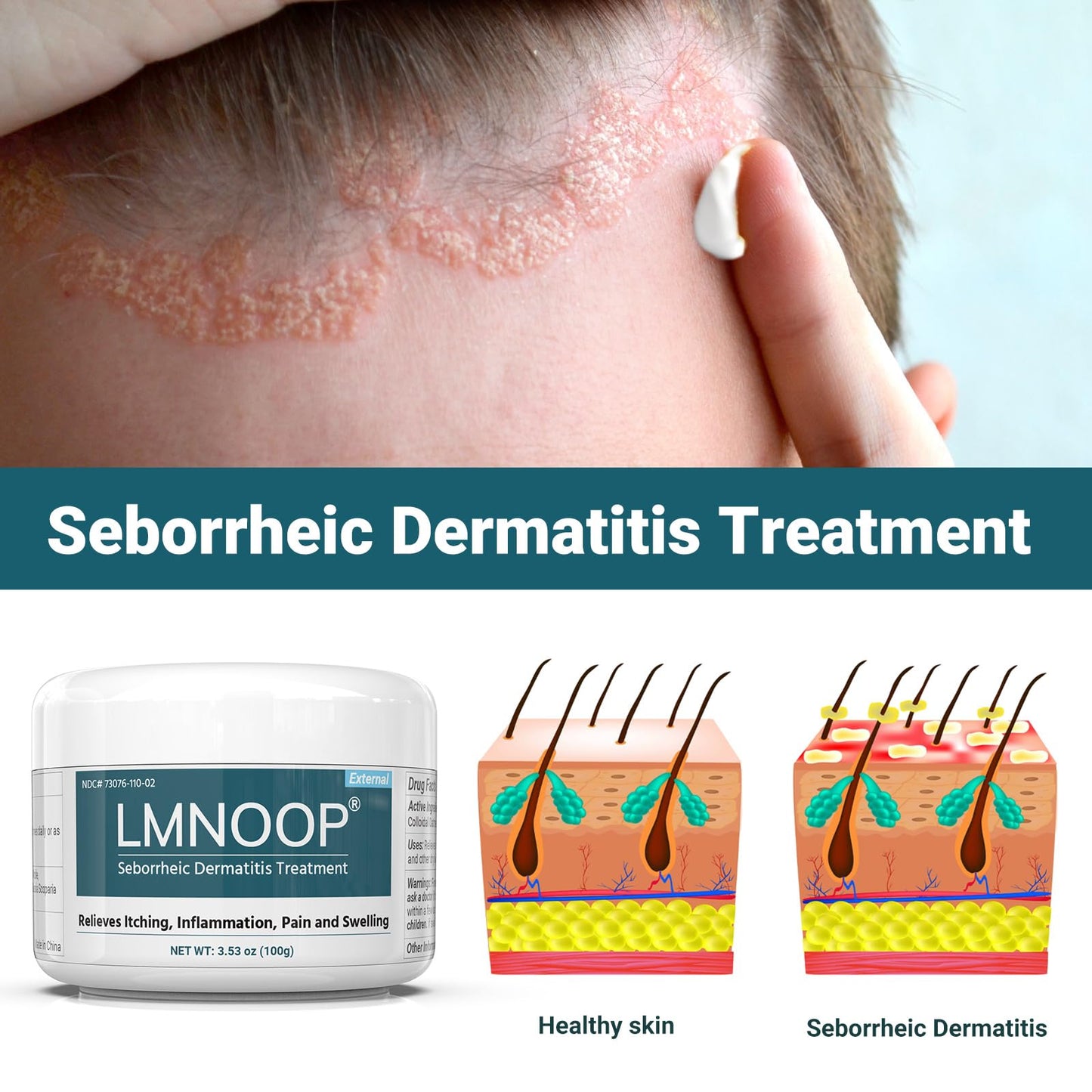 Extra Strength Seborrheic Dermatitis Cream & Scalp Treatment - Effectively Treats Psoriasis, Eczema, Dandruff, Folliculitis, Dry & Itchy Scalp - Anti-Itch, Soothing Relief - 3.5 oz