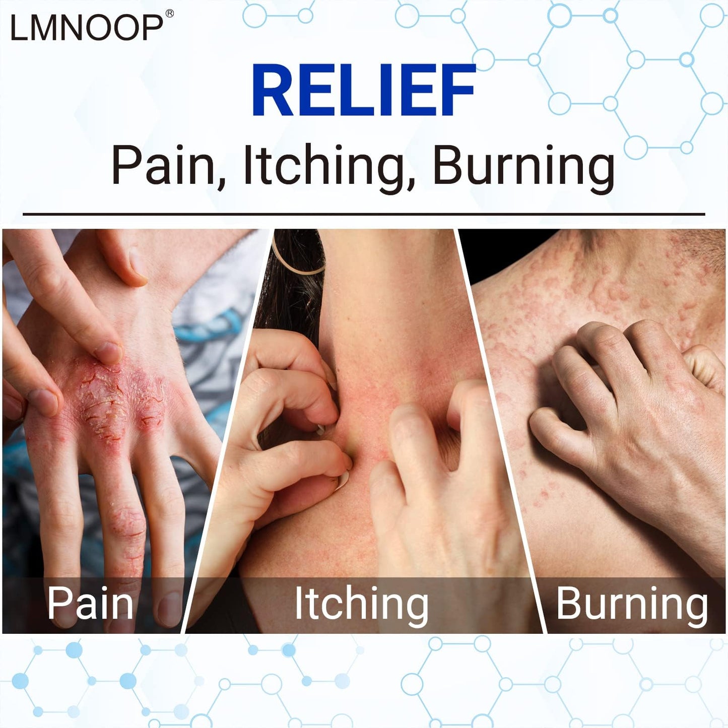 LMNOOP® Eczema Cream, Maximum Strength Treatment Ointment for Dermatitis, Rash, Psoriasis, Urticaria, Tinea Pedis, Fungal Infection, Anti-Itch, Relief for Sensitive & Irritated Skin, 1.76oz 2PCS