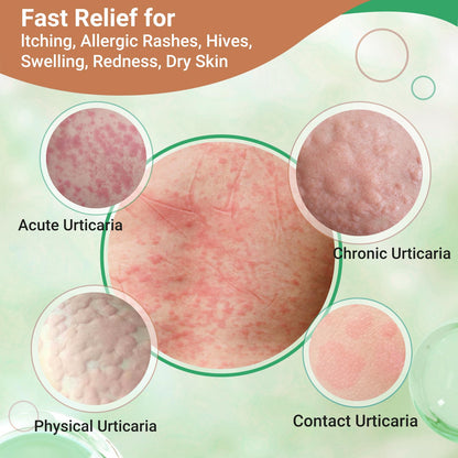 Urticaria Cream for Hives Relief - Fast Acting Anti Itch Treatment with All Natural Herbal Formula for Skin Allergic Rashes, Redness, Swelling 7.06 oz