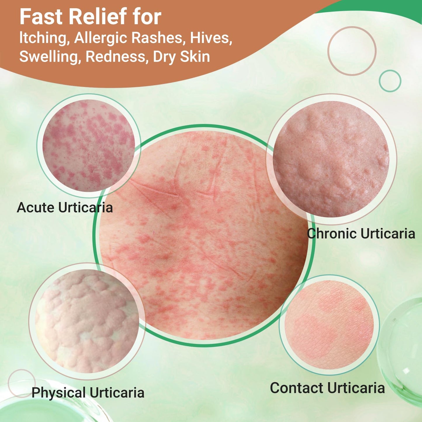 Urticaria Cream for Hives Relief - Fast Acting Anti Itch Treatment with All Natural Herbal Formula for Skin Allergic Rashes, Redness, Swelling 3.53 oz