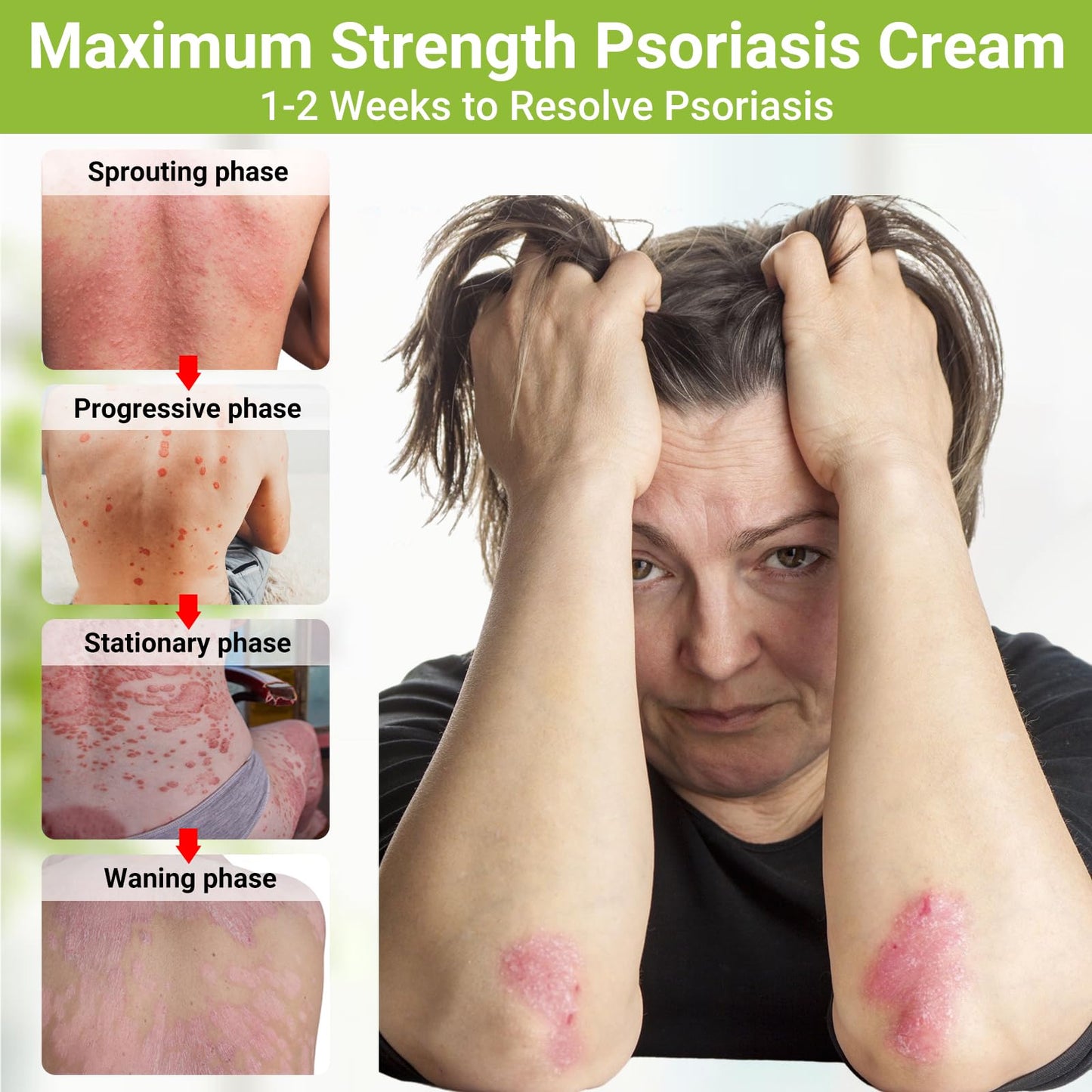 Psoriasis Cream, Maximum Strength Treatment Moisturizing Cream for Psoriasis, Dermatitis, Rash, Anti-Itch, Redness, Flaking, Scaling, Fast Acting Relief for Irritated, Dry Skin 3.53oz