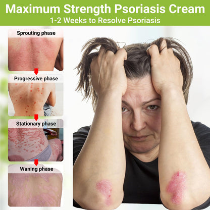 Psoriasis Cream, Maximum Strength Treatment Moisturizing Cream for Psoriasis, Dermatitis, Rash, Anti-Itch, Redness, Flaking, Scaling, Fast Acting Relief for Irritated, Dry Skin 3.53oz