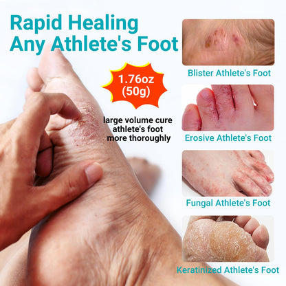Athletes Foot Treatment Cream, Maximum Strength for Athlete's Foot (Tinea Pedis), Itching, Blister, Burning, Cracking, Scaling, Beriberi,Natural Herbs Antifungal Foot Cream (2-Pack)