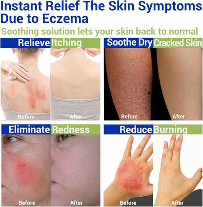 Eczema Cream for Dry, Itchy, Irritated, and Eczema Prone Skin, Maximum Strength Treatment Ointment for Rash, Psoriasis, Dermatitis(7.05oz)