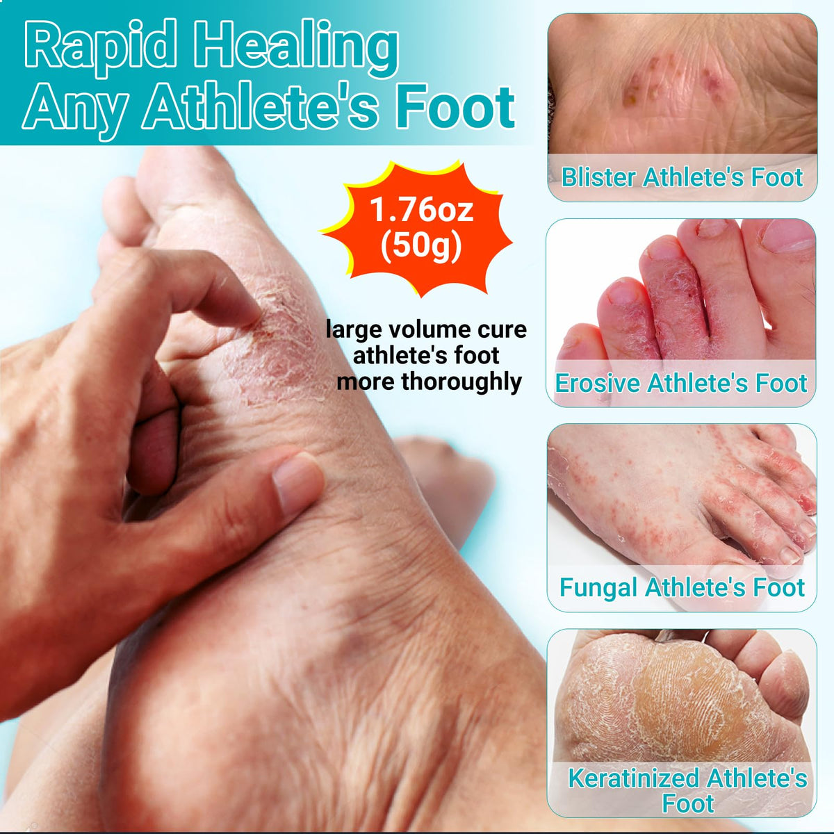 Athletes Foot Treatment Cream, Maximum Strength for Athlete's Foot (Tinea Pedis), Itching, Blister, Burning, Cracking, Scaling, Beriberi,Natural Herbs Antifungal Foot Cream