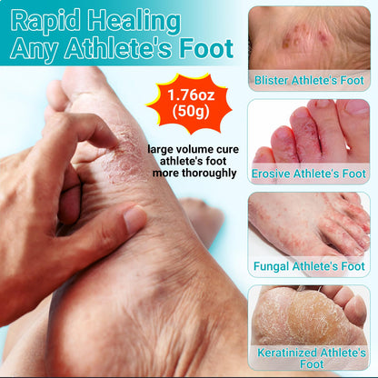 Athletes Foot Treatment Cream, Maximum Strength for Athlete's Foot (Tinea Pedis), Itching, Blister, Burning, Cracking, Scaling, Beriberi,Natural Herbs Antifungal Foot Cream