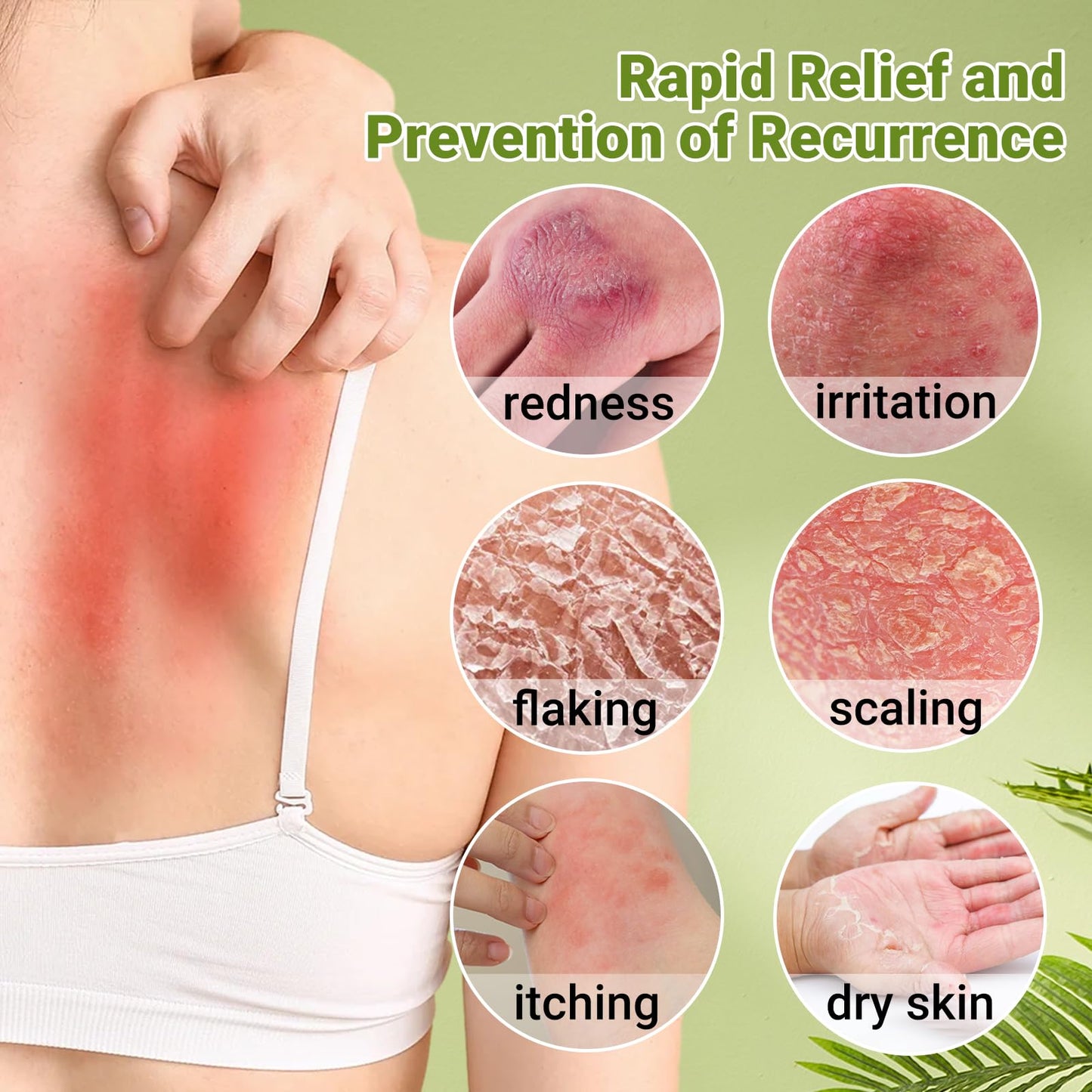Psoriasis Cream, Maximum Strength Treatment Moisturizing Cream for Psoriasis, Dermatitis, Rash, Anti-Itch, Redness, Flaking, Scaling, Fast Acting Relief for Irritated, Dry Skin 3.53oz