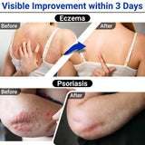 Eczema Cream LMNOOP for Dry, Itchy, Irritated and Eczema Prone Skin, A Variety of Natural Herbal Extracts for Eczema,Psoriasis, Jock Itch,Steroid-Free and Fragrance-Free (50g)