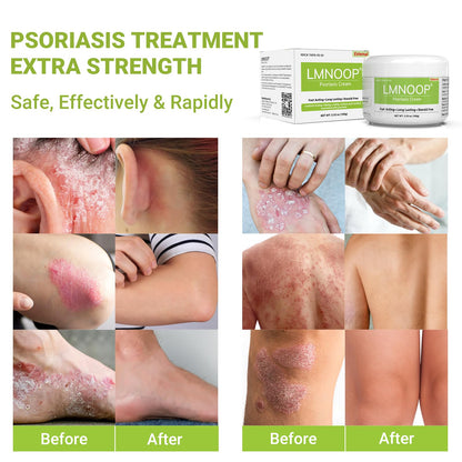 Psoriasis Cream, Maximum Strength Treatment Moisturizing Cream for Psoriasis, Dermatitis, Rash, Anti-Itch, Redness, Flaking, Scaling, Fast Acting Relief for Irritated, Dry Skin 3.53oz