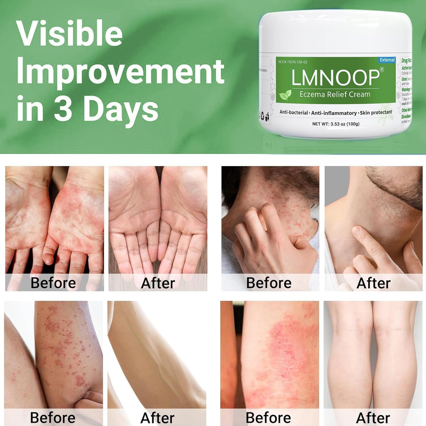 Eczema Cream for Dry, Itchy, Irritated, and Eczema Prone Skin, Maximum Strength Treatment Ointment for Rash, Psoriasis, Dermatitis (Contains Menthol) 3.53oz