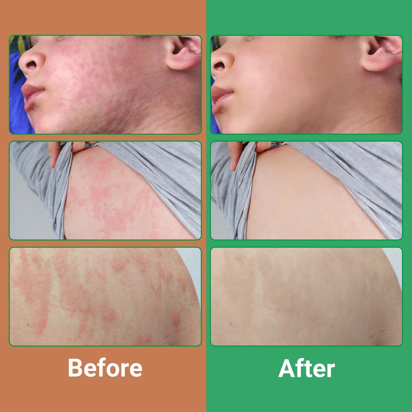 Urticaria Cream for Hives Relief - Fast Acting Anti Itch Treatment with All Natural Herbal Formula for Skin Allergic Rashes, Redness, Swelling 7.06 oz