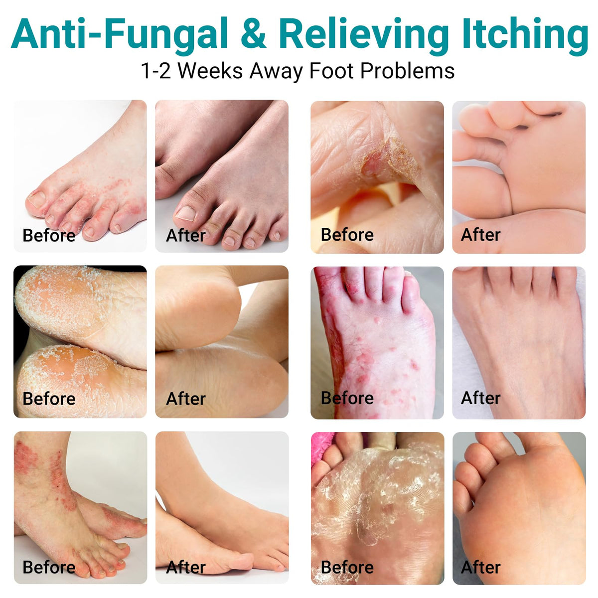 Athletes Foot Treatment Cream, Maximum Strength for Athlete's Foot (Tinea Pedis), Itching, Blister, Burning, Cracking, Scaling, Beriberi,Natural Herbs Antifungal Foot Cream (2-Pack)