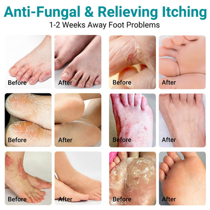 Athletes Foot Treatment Cream, Maximum Strength for Athlete's Foot (Tinea Pedis), Itching, Blister, Burning, Cracking, Scaling, Beriberi,Natural Herbs Antifungal Foot Cream (2-Pack)