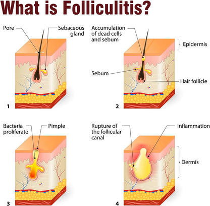 Folliculitis Treatment Cream, Natural Ingredients, Valid Relieve, for Itching, Lichen, Redness, Inflammation, Fast Non-Irritating - 3.52oz