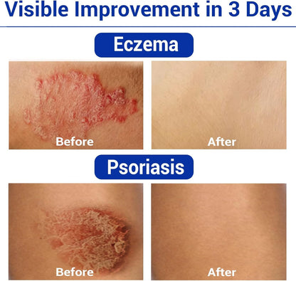 Eczema Cream for Dry, Itchy, Irritated, and Eczema Prone Skin, Maximum Strength Treatment Ointment for Rash, Psoriasis, Dermatitis(7.05oz)
