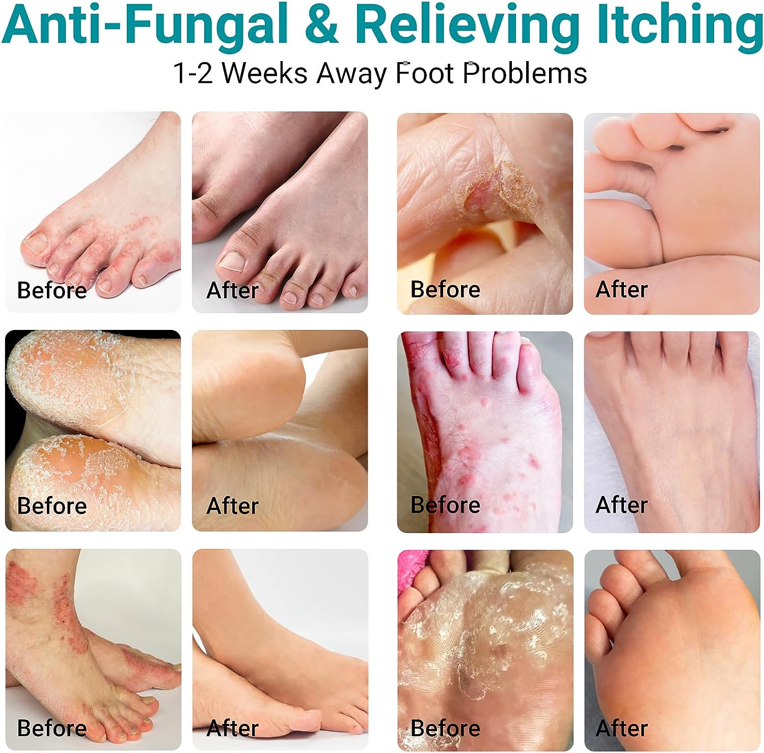 LMNOOP® Athletes Foot Treatment Cream, Maximum Strength for Athlete's