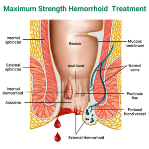 LMNOOP® Hemorrhoid Treatment Ointment, Maximum Strength Treatment & Fast Relief for Pain, Itching, Burning, Swelling, Fissure, Bleeding, Discomfort, Long-Lasting Internal & External Hemorrhoid Cream